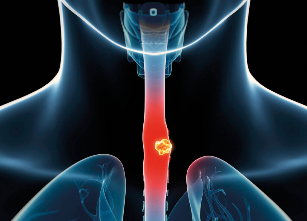 Esophageal Cancer Treatment